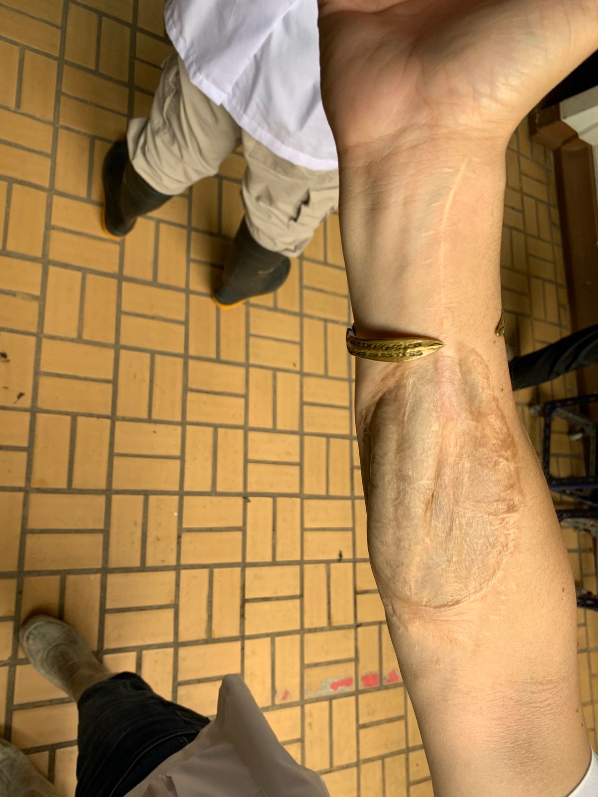 先生のコブラに噛まれた右手だそうです！